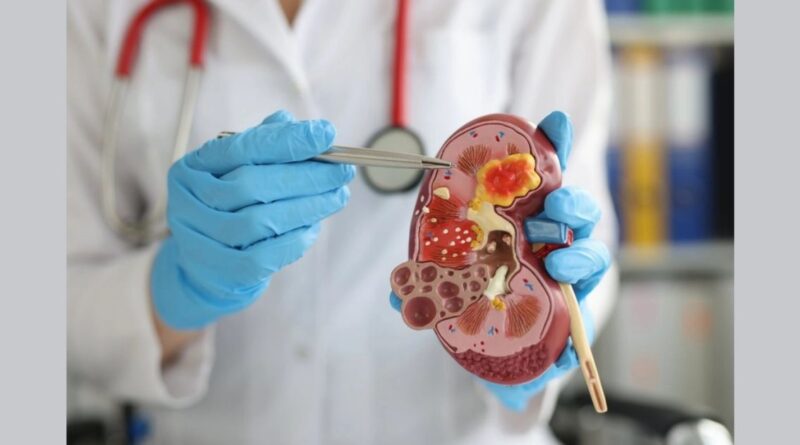 kidneycabcer